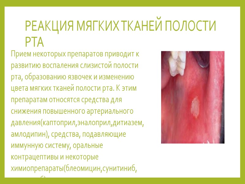 РЕАКЦИЯ МЯГКИХ ТКАНЕЙ ПОЛОСТИ РТА  Прием некоторых препаратов приводит к развитию воспаления слизистой